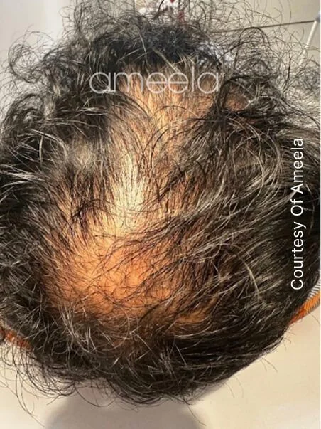 Ameela Polynucleotides treatment in action before result
