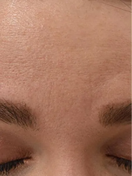 Baby Botox Results 
 before result