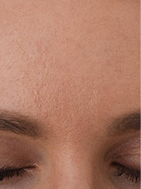 Baby Botox treatment in action
 after result
