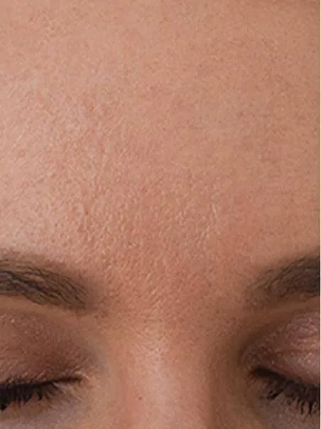 Baby Botox Results 
 after result