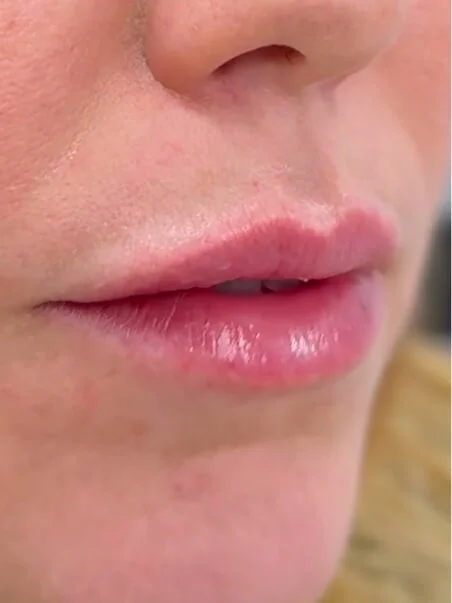 Lip Enhancement treatment in action
 after result