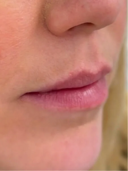 Lip Enhancement treatment in action
 before result