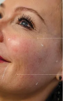 Profhilo treatment in action before result