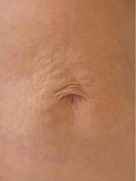 Profhilo treatment in action after result