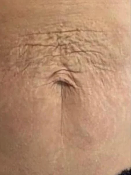 Profhilo treatment in action before result