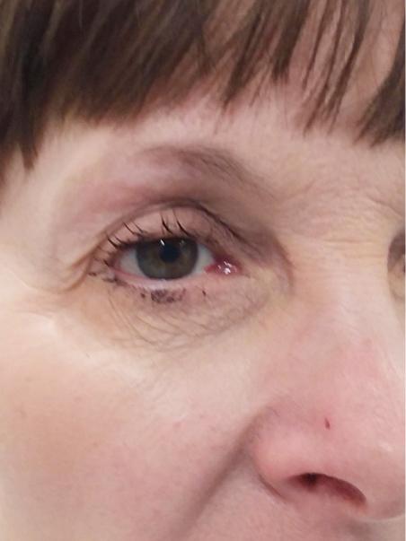 Tear trough after|rtwskin.co.uk