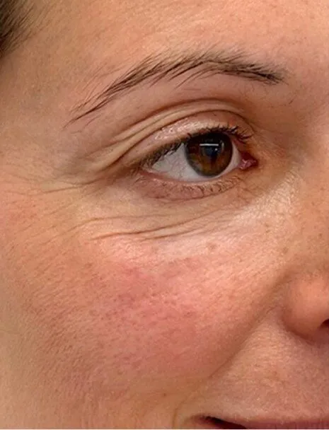 Ameela Polynucleotides treatment in action
 after result