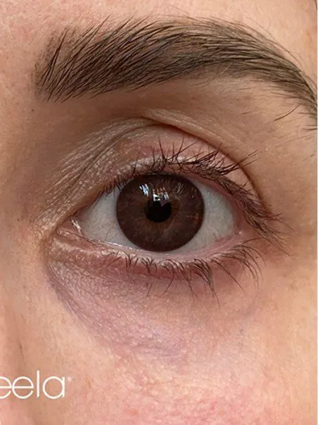 Ameela Polynucleotides treatment in action
 after result