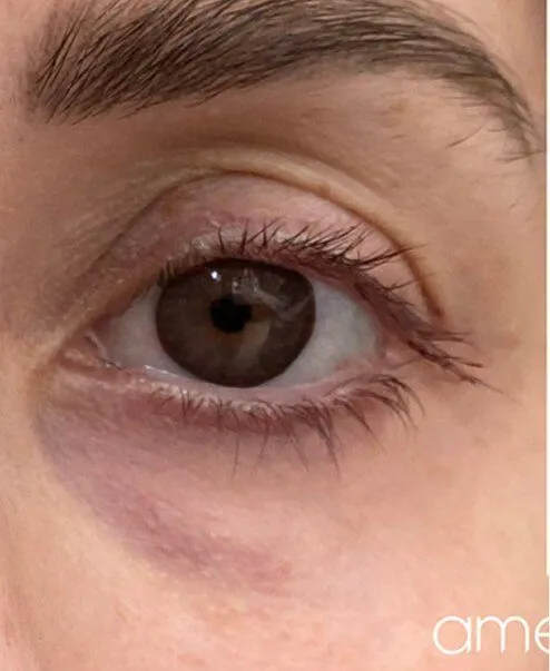 Ameela Polynucleotides treatment in action
 before result