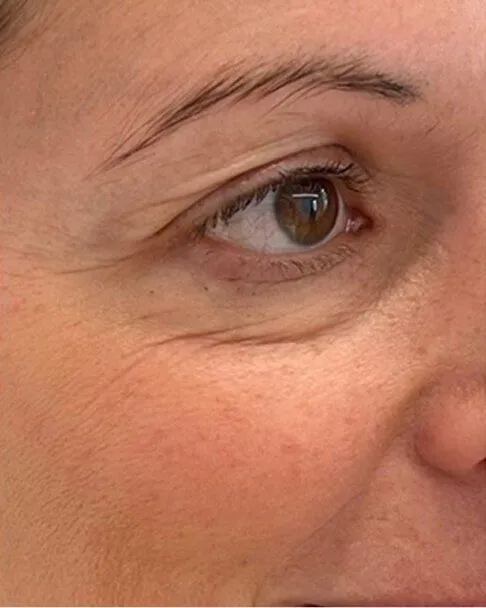 Ameela Polynucleotides treatment in action
 before result