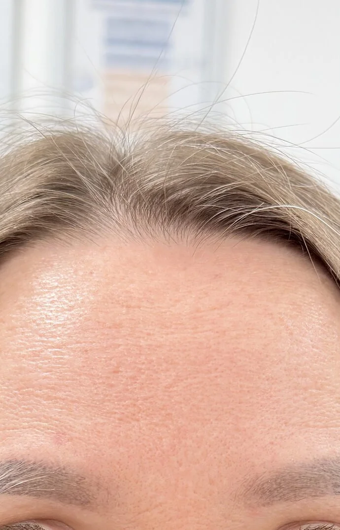 Anti-Wrinkle Treatments in action after results