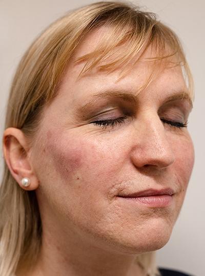 cheek-enhancement-after|rtwskin.co.uk