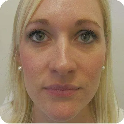 dermal-fillers-after|rtwskin.co.uk