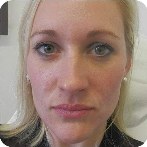 dermal-fillers-before|rtwskin.co.uk