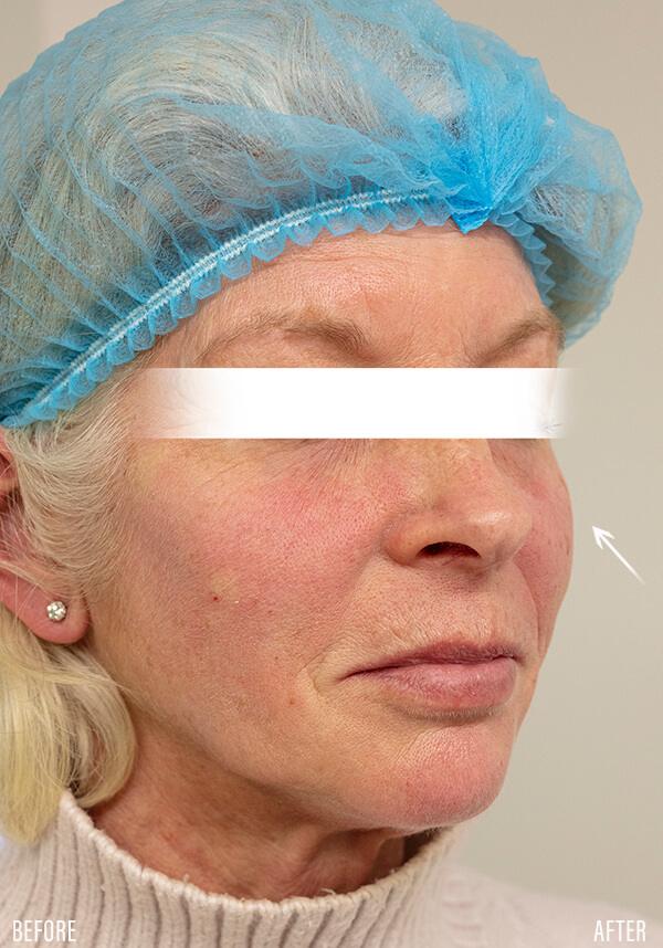 ellanse-after|rtwskin.co.uk