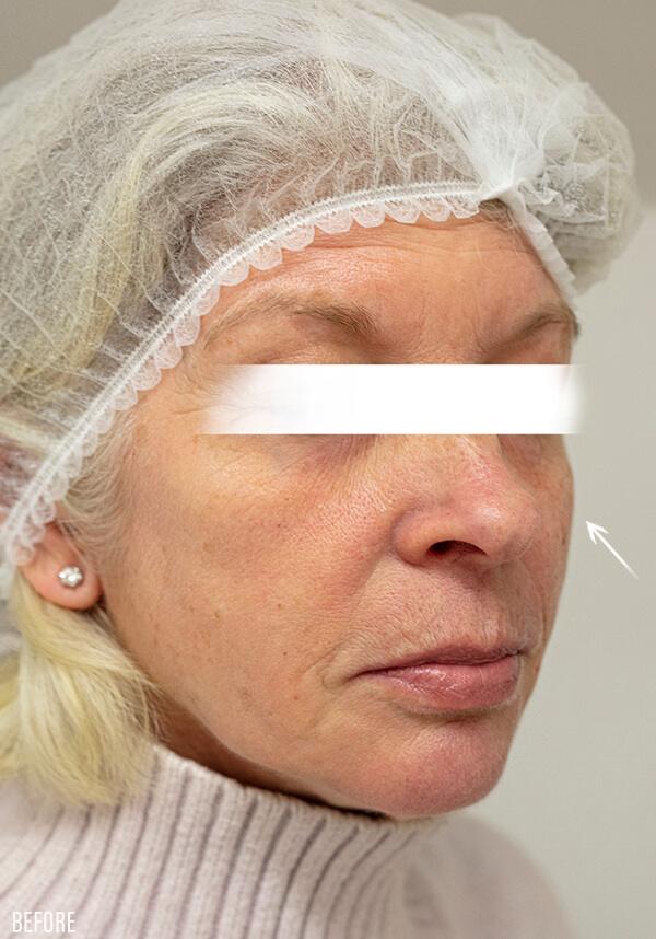 ellanse-before|rtwskin.co.uk
