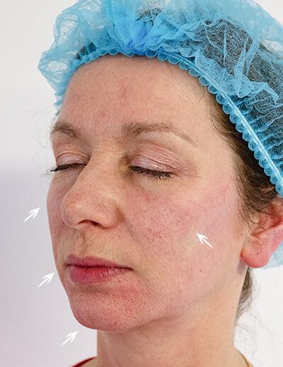 ellanse-cheek-enhancement-after|rtwskin.co.uk