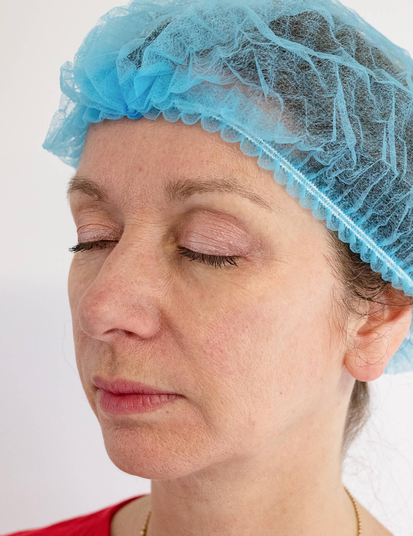 ellanse-cheek-enhancement-before|rtwskin.co.uk