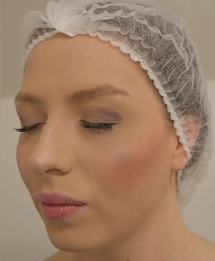 emily-cheeks-after-side|rtwskin.com.uk