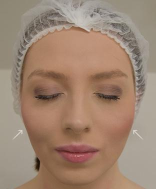 emily-cheeks-after|rtwskin.co.uk