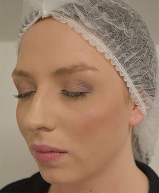emily-cheeks-before-side|rtwskin.co.uk