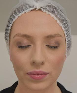 emily-cheeks-before|rtwskin.co.uk