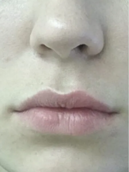Lip Enhancement treatment in action
 after result