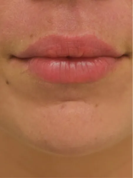 Lip Enhancement treatment in action
 after result