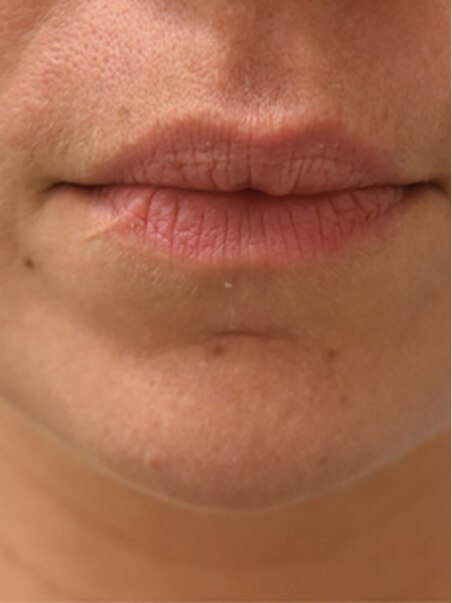 Lip Enhancement treatment in action
 before result