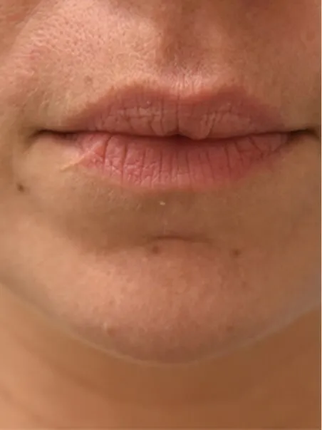 Lip Enhancement treatment in action
 before result