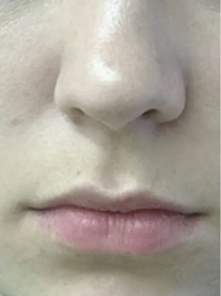 Lip Enhancement treatment in action
 before result