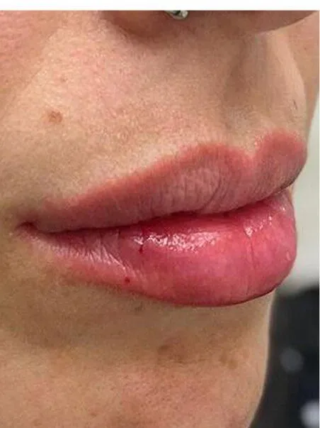 Lip Enhancement treatment in action
 after result