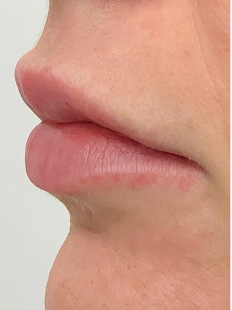 Lip Enhancement treatment in action
 after result