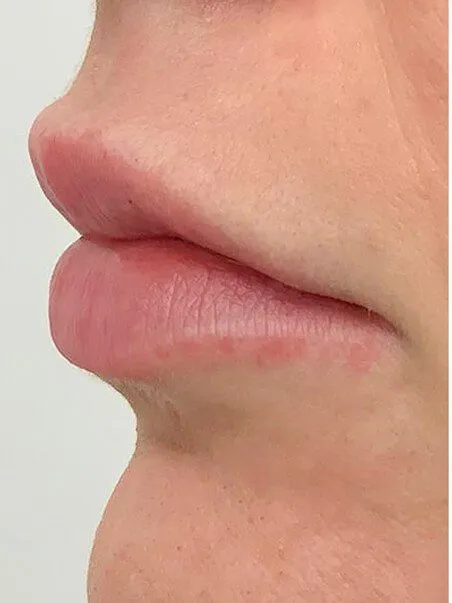 Lip Enhancement treatment in action
 after result