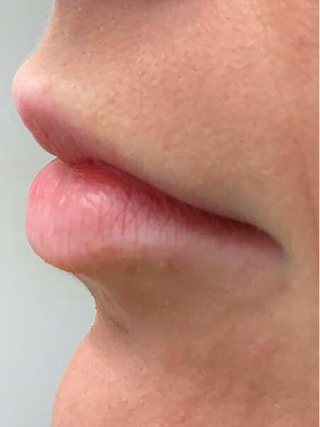 Lip Enhancement treatment in action
 before result