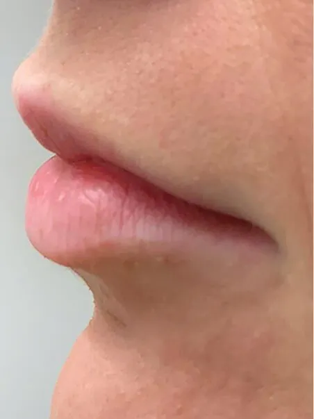 Lip Enhancement treatment in action
 before result