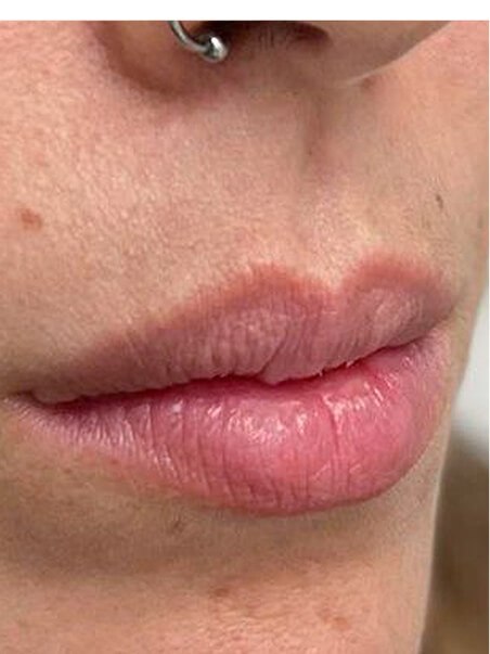 Lip Enhancement treatment in action
 before result