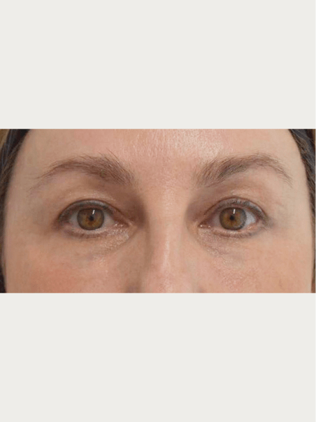 tear trough after|rteskin.co.uk