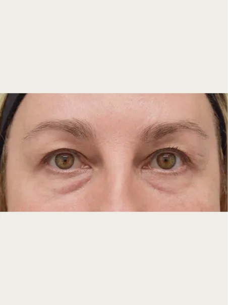 tear trough before|rtwskin.co.uk