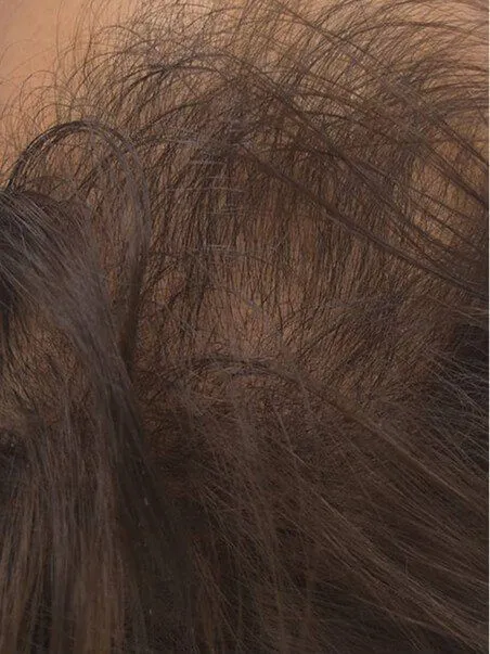 PRP Hair Restoration Before and After
 after result