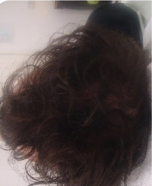 PRP Hair Restoration Before and After
 after result