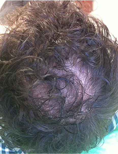 PRP Hair Restoration Before and After
 before result