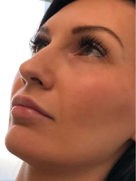 Lip Enhancement treatment in action
 after result