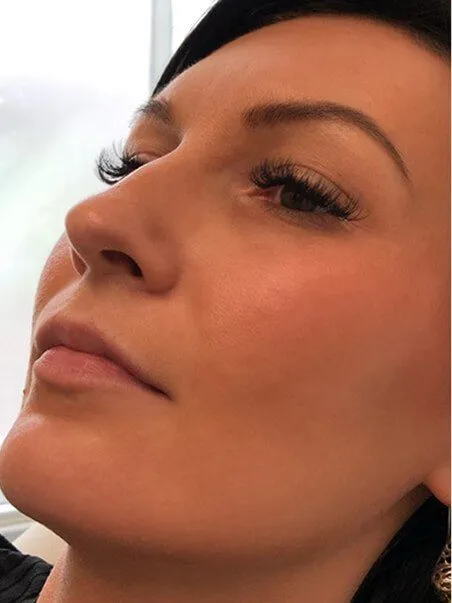 Lip Enhancement treatment in action
 before result