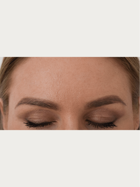 Anti-Wrinkle Treatments in action after results