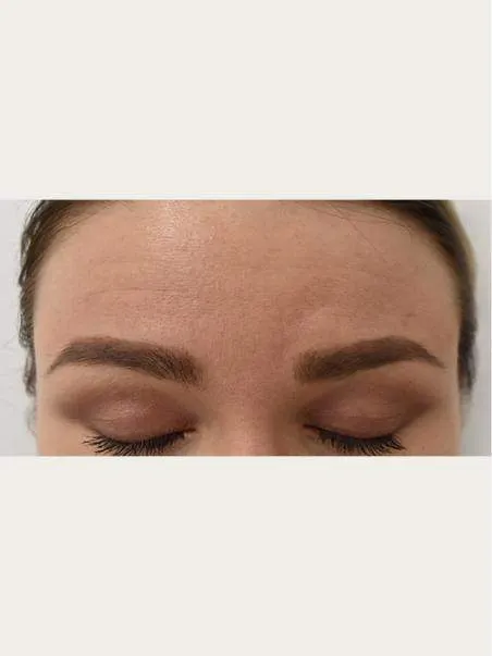 Anti-Wrinkle Treatments in action before results