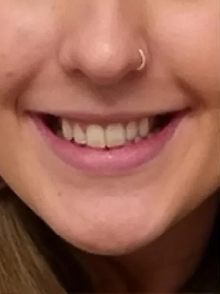 Botox Gummy Smile treatment in action
 after result