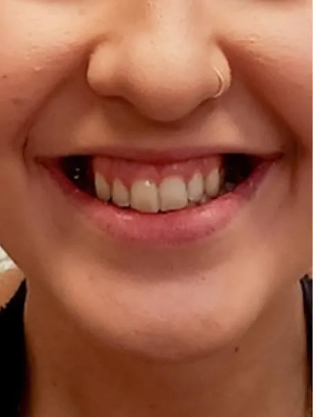 Botox Gummy Smile treatment in action
 before result