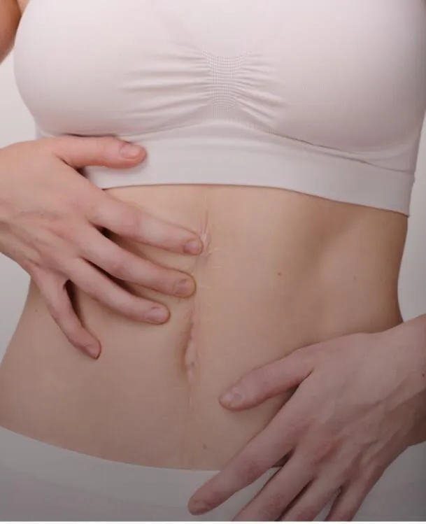 <p class="p1"><b>Scars, Stretch Marks</b></p>
 image