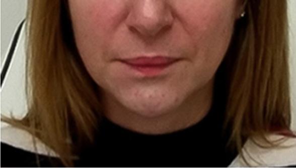 Result patient after